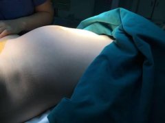 11岁女孩取出6斤卵巢肿瘤 手术前腹胀如孕妇(图